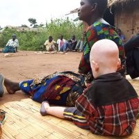 말라위: 살인 부추기는 전통 의술사, 알비노에 대한 공격을 멈춰라!